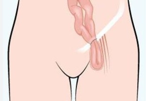 Tổng quan bệnh thoát vị đùi